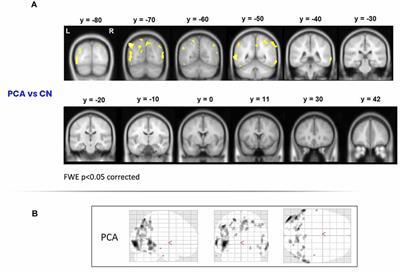 What’s “up”? Impaired Spatial Preposition Processing in Posterior Cortical Atrophy